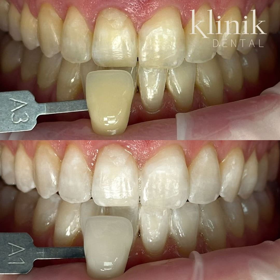 Blanqueamiento dental Philips Zoom